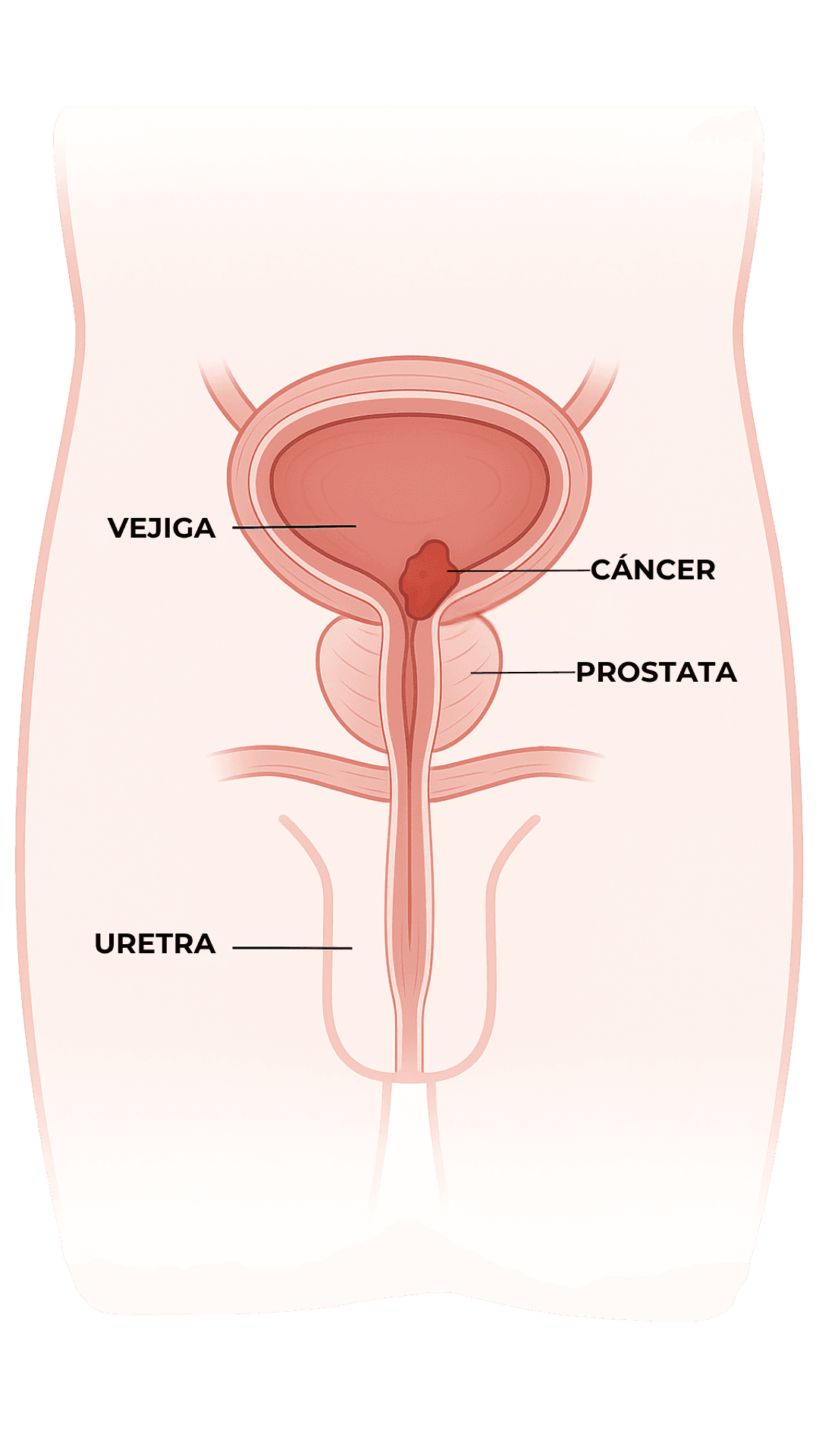 Anatomía - Cáncer de Vejiga