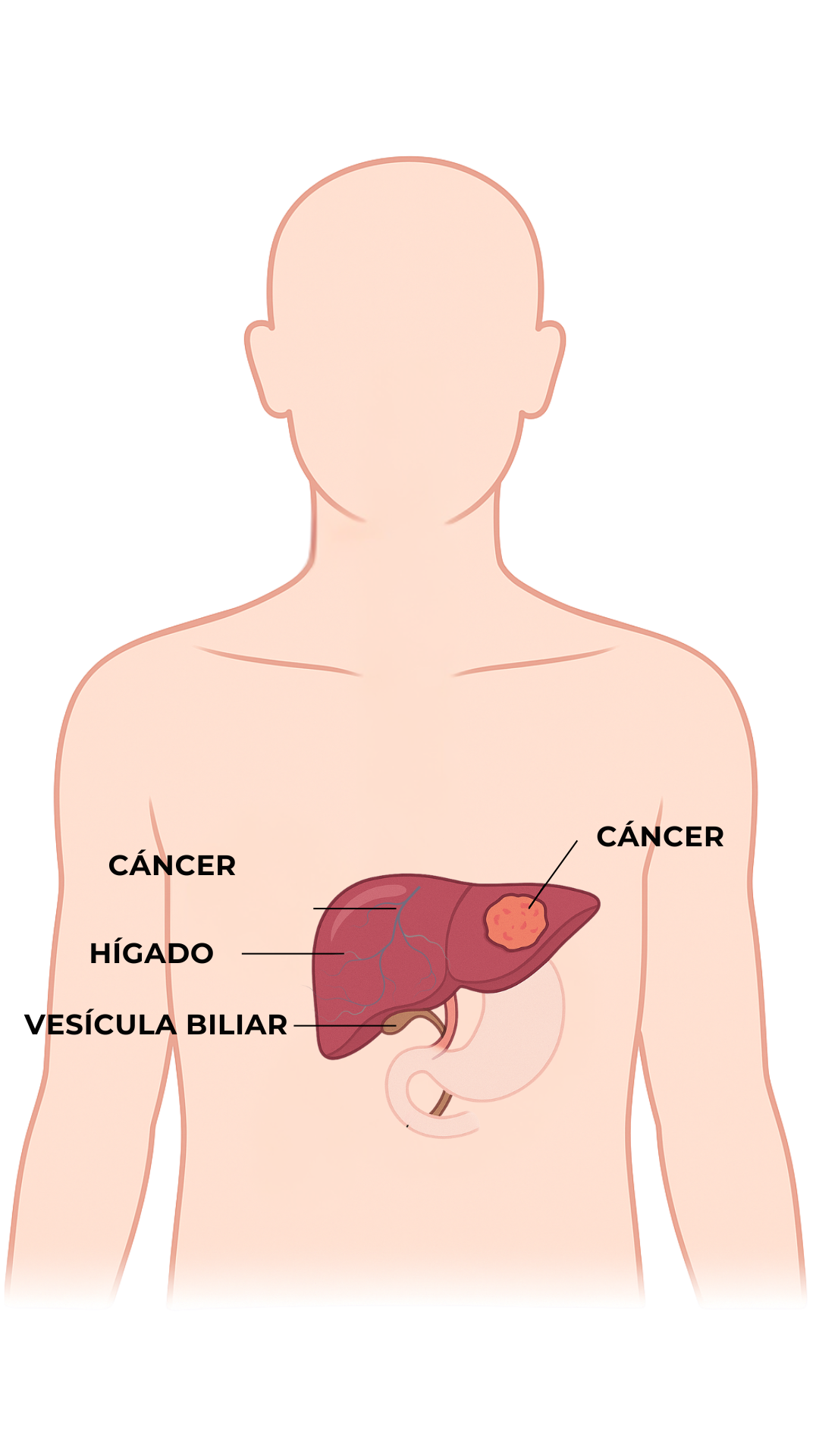 Anatomía - Cáncer de Hígado
