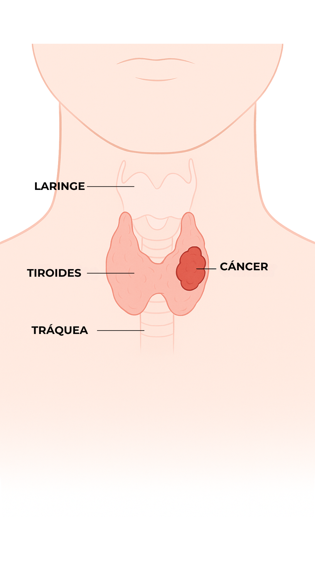 Anatomía - Cáncer de Tiroides
