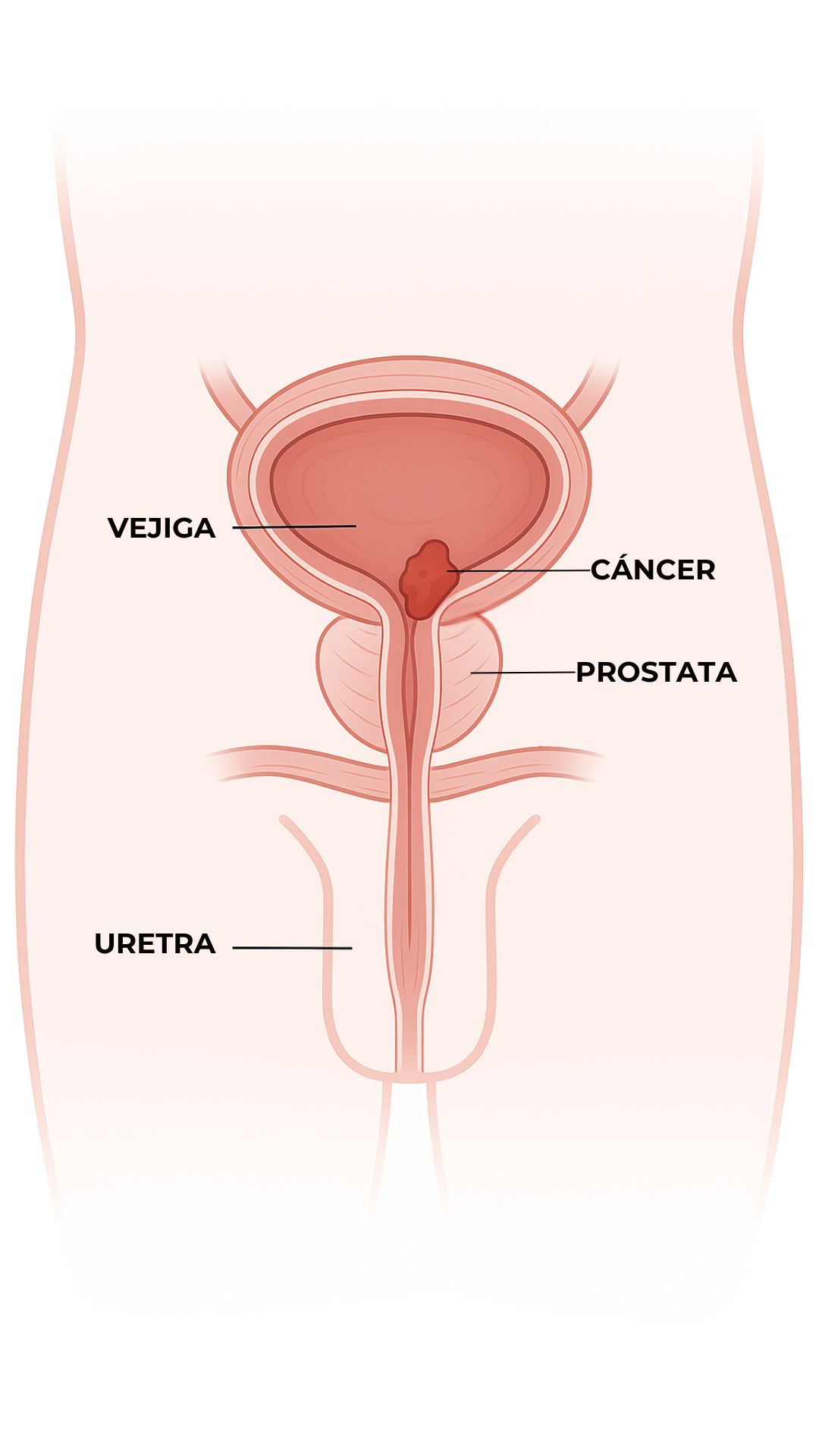 Anatomía - Cáncer de Vejiga